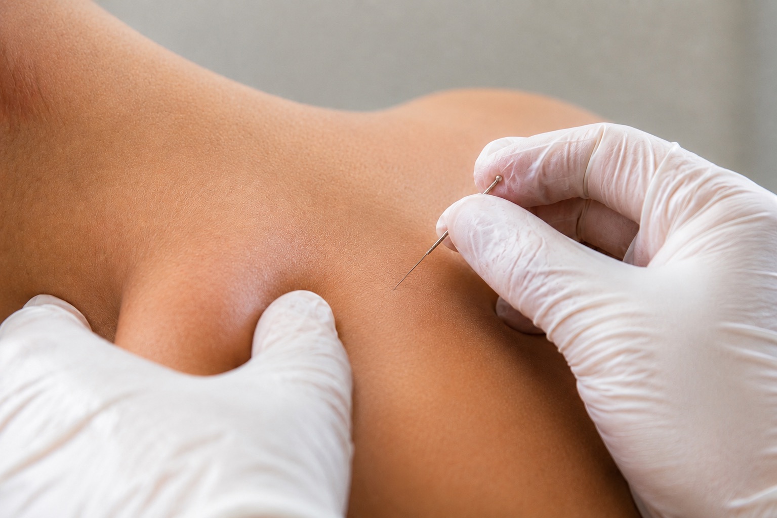 Fisioterapia invasiva ecoguiada en FICAN